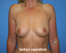 plastic-surgery-breast-augmentation
